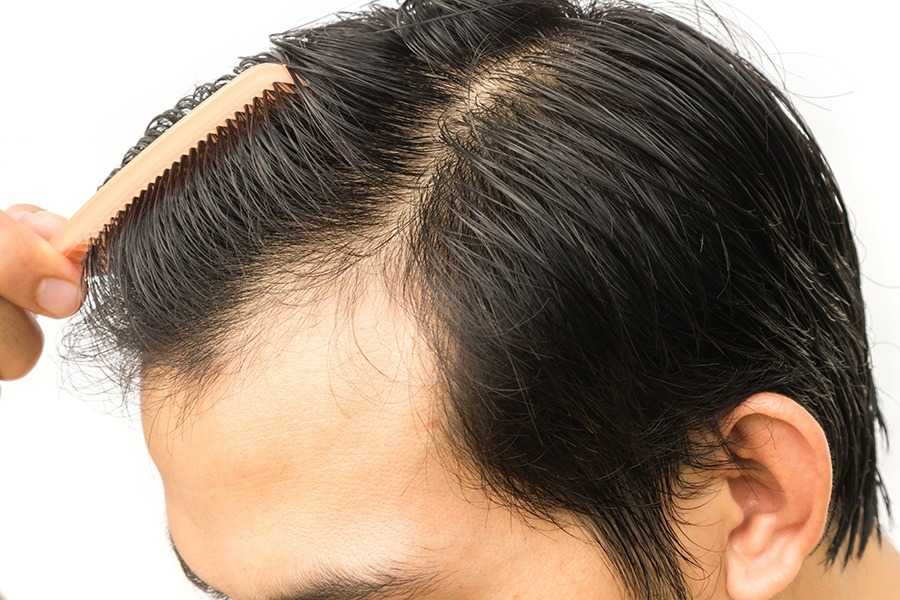 Bằng cách nào phẫu thuật cấy tóc giúp bạn có mái tóc khỏe mạnh tự nhiên?