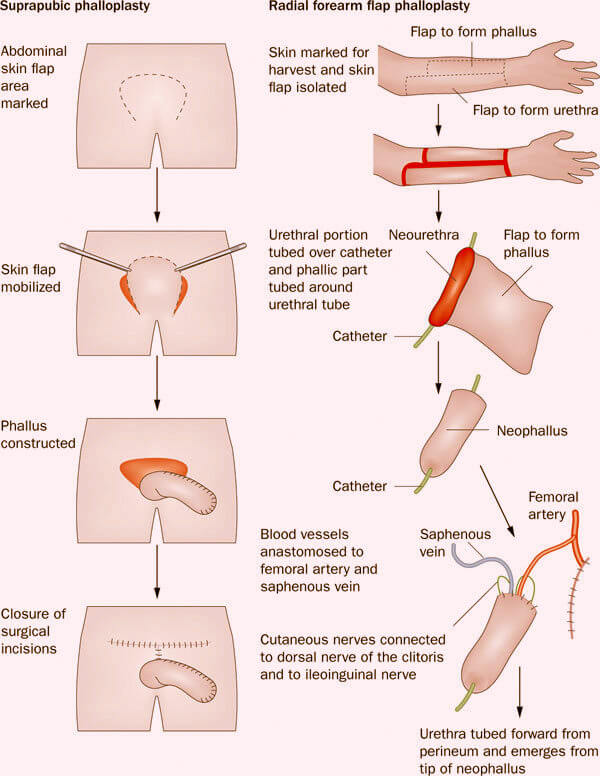 Phẫu thuật bộ phận sinh dục từ nữ sang nam