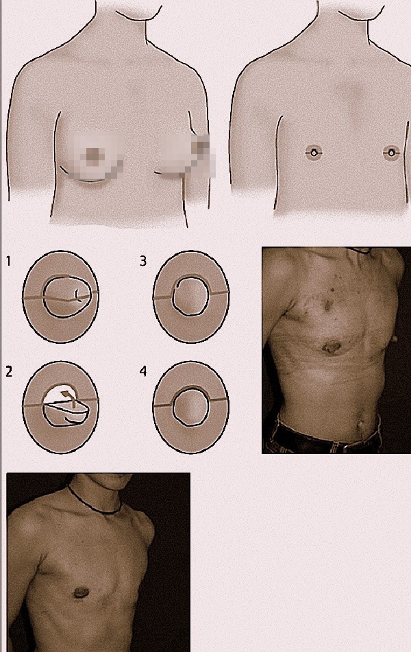 Giai đoạn cắt bỏ bầu ngực tạo bộ ngực phẳng